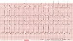 ECG3