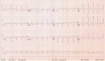 ECG1
