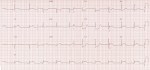 ECG2