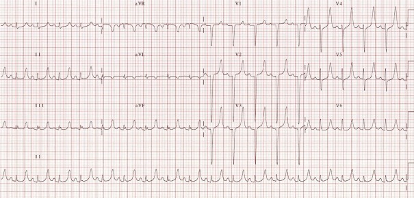 ecg-potassium-7-peaked-t-waves