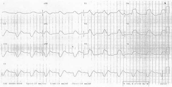 ecg90406-hyperkalaemia-pr-lengthens